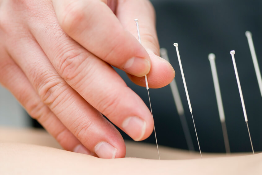 7 Benefits of Acupuncture for Seniors