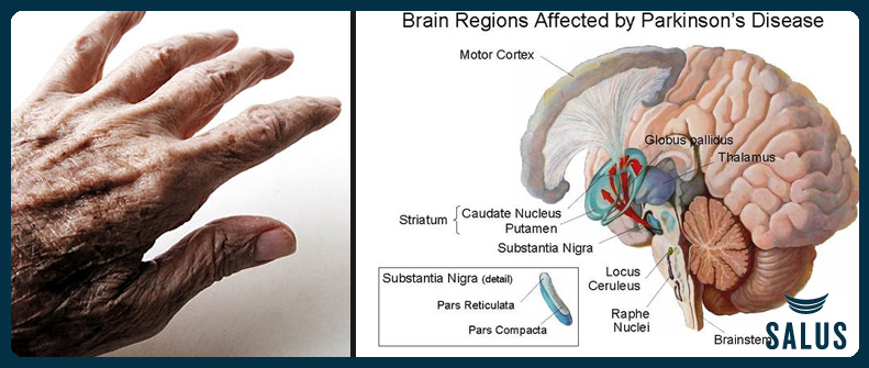 Targeted Exercise, Physical Therapy and Parkinson’s Disease