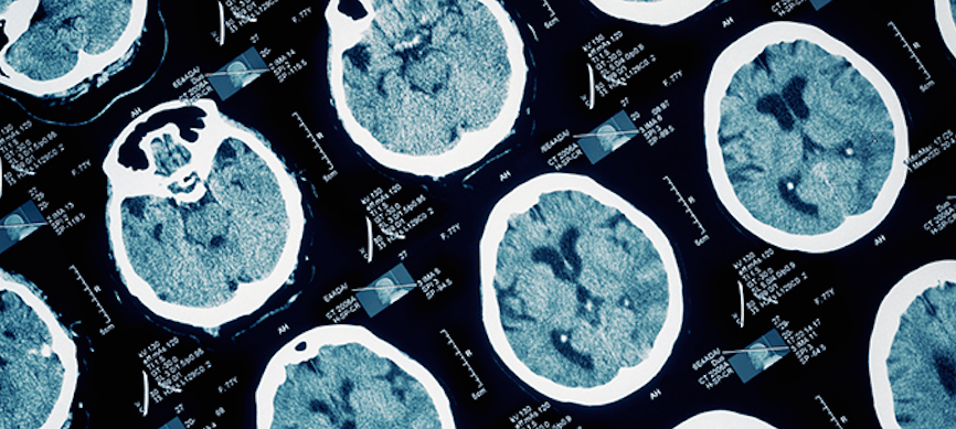 San Diego Seniors Surviving a Brain Injury