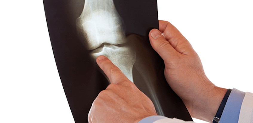 Osteoporosis Can Affect Men Too